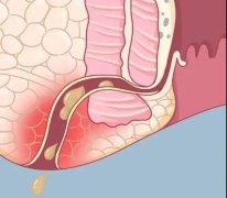 【宜昌肛泰医院怎么样】“菊部”出现这5个症状，要当心肛瘘！